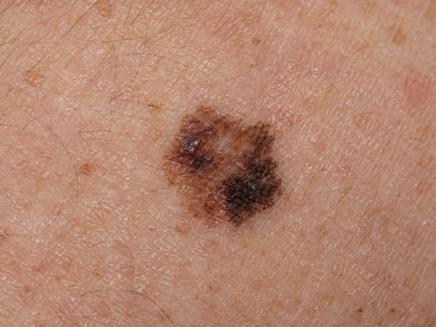 Skin lesion image